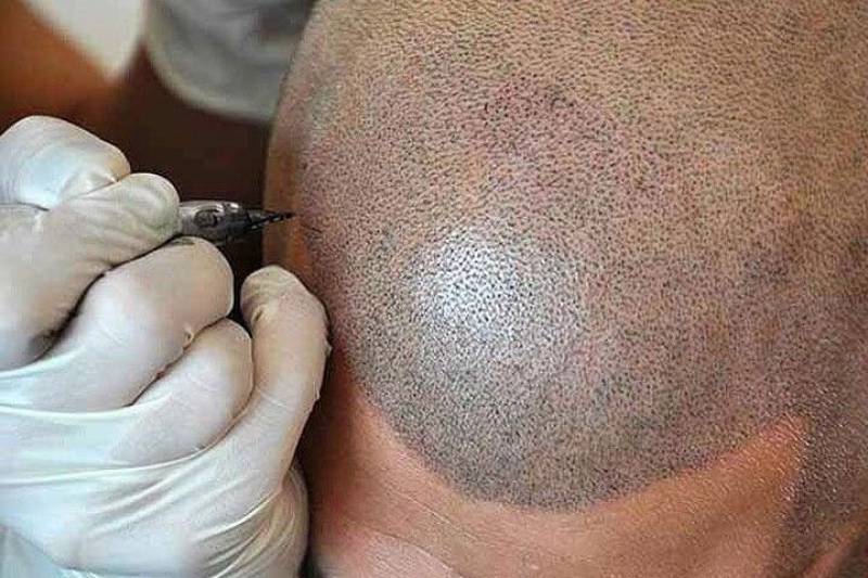 Collecte des DASRI de dermopigmentation et micropigmentation capillaire à Montpellier